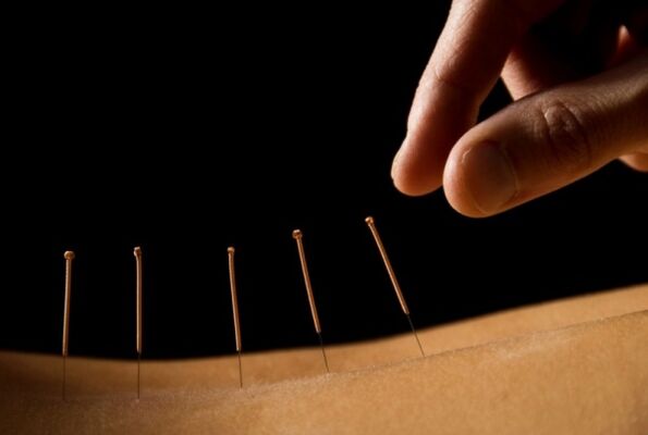 L'acupuncture aide à soulager les douleurs lombaires
